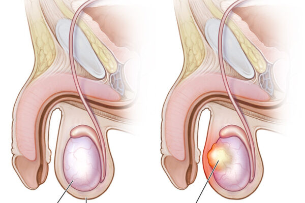 Testicular Shape Changes: Know When Prompt Checking Matters