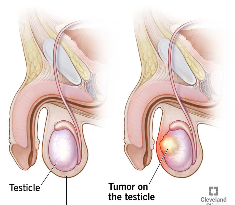 Testicular Shape Changes: Know When Prompt Checking Matters
