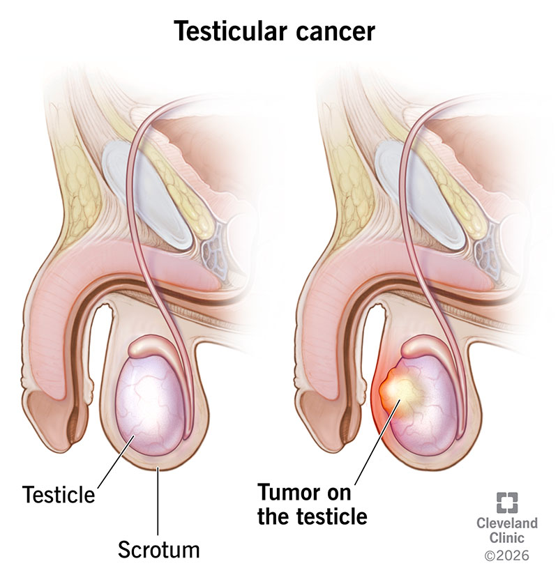 Testicular Shape Changes: Know When Prompt Checking Matters
