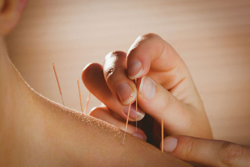 5 Best Acupuncturists in Cardiff - Natural relief for chronic pain